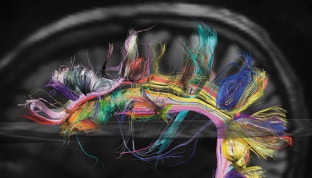 MRI Brain Scan